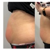 Image 3: Transform Your Look with Choice of Cavitation Options