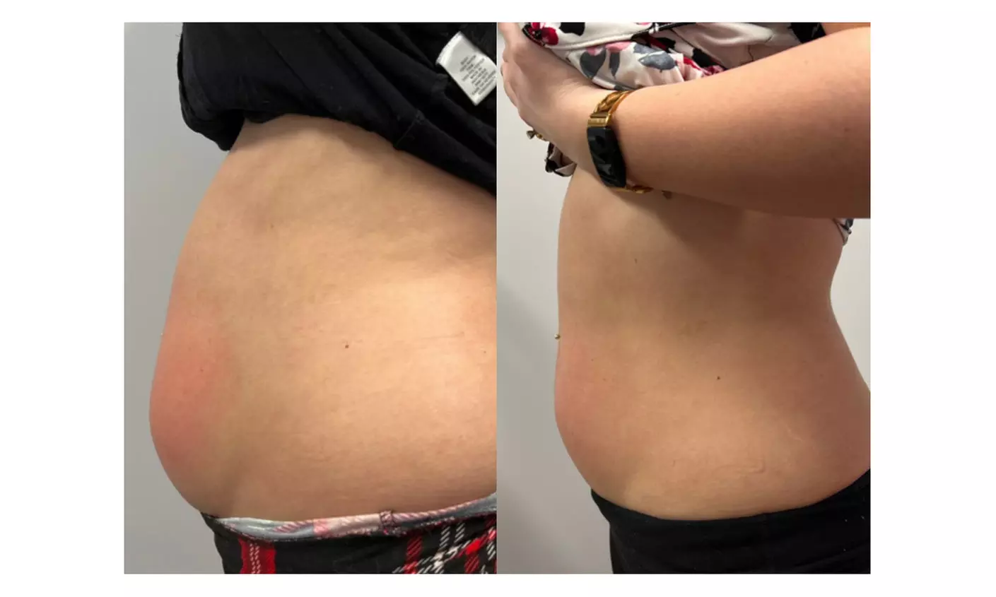 Transform Your Look with Choice of Cavitation Options