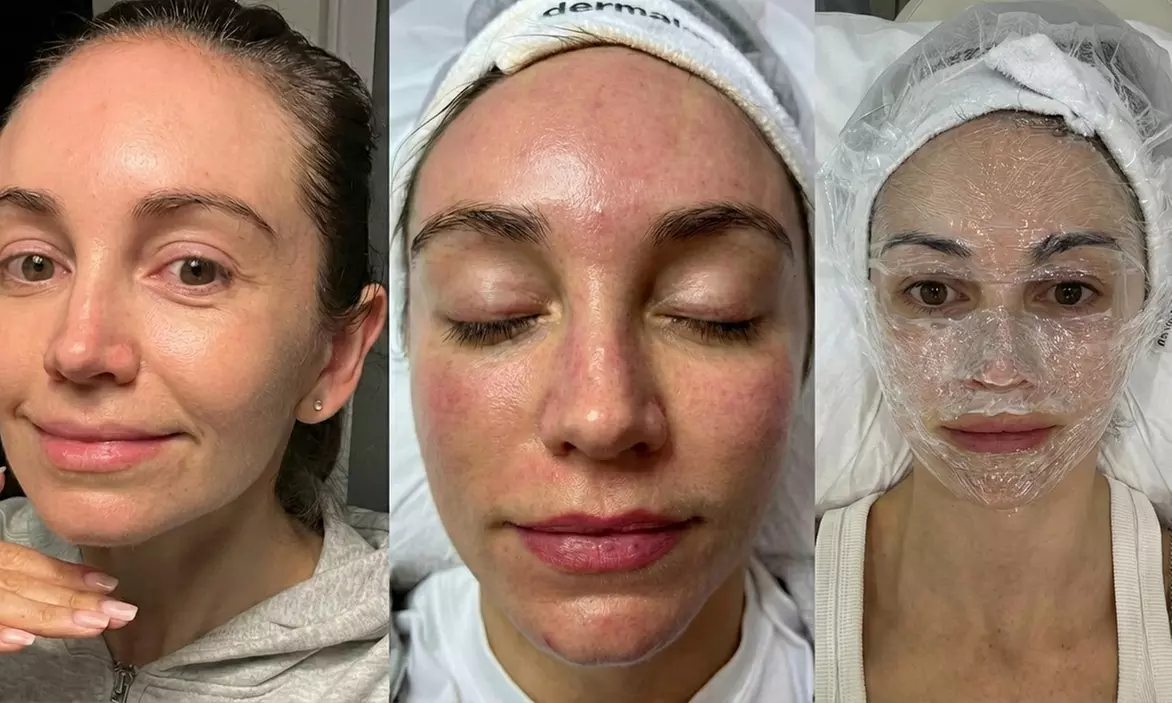 Medical Microneedling Facial with Hyaluronic Acid