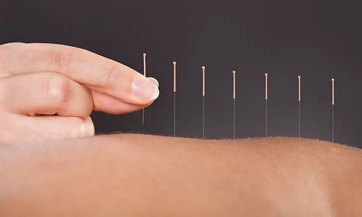 Get Relief with Initial Consultation w/ One Acupuncture Session at Oriental Acupuncture Center ( Up to 52% Off ) - Primary Image