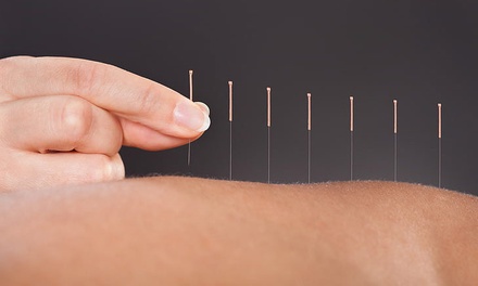 Initial Consultation with One Acupuncture Session - Oriental Acupuncture Center