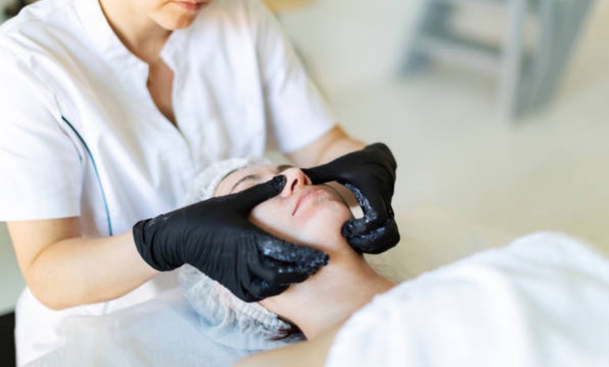 Image 7: Hollywood peeling con mascarilla de carbón activo y láser