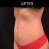 Image 1: Lipo Laser Body Contouring Sessions for Targeted Inch Reduction