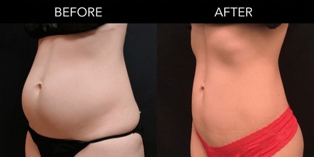 1 Lipo Laser   Body Contouring + Lymphatic Drainage - Todabonita4U Aesthetics & Wellness