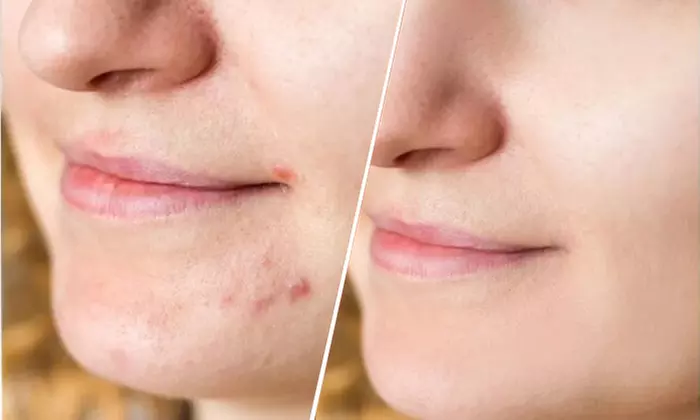 Get One or Two Morpheus8 Sessions w/ Optional 20 or 40 Units of Xeomin