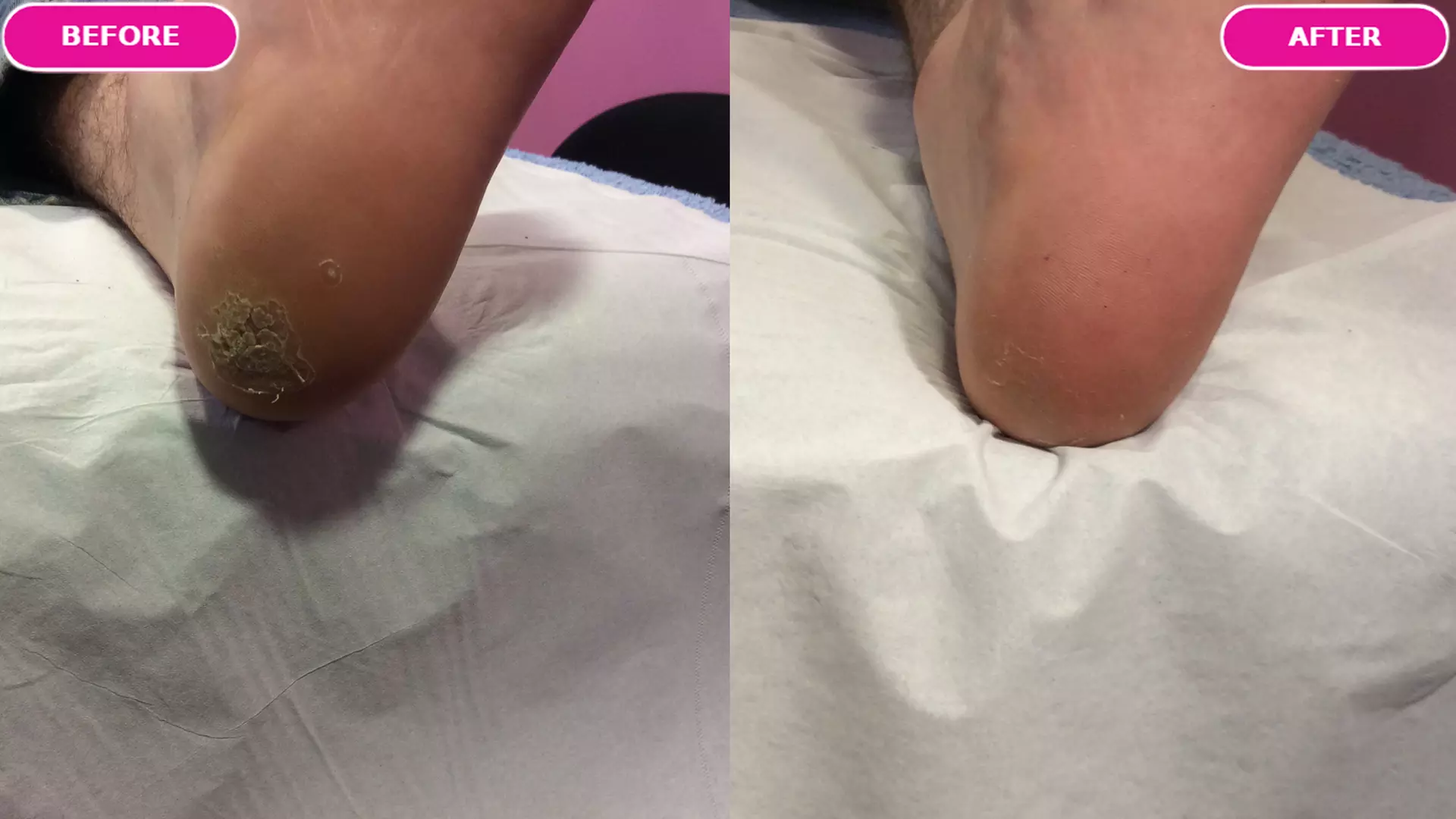 Expert Treatment of Up to 3 Warts or Verrucas (Up to 84%)