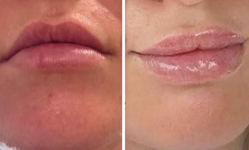 Image 4: Half (0.55mL) or Full Syringe  (1mL) Lip Filler - Limited Time Deposit