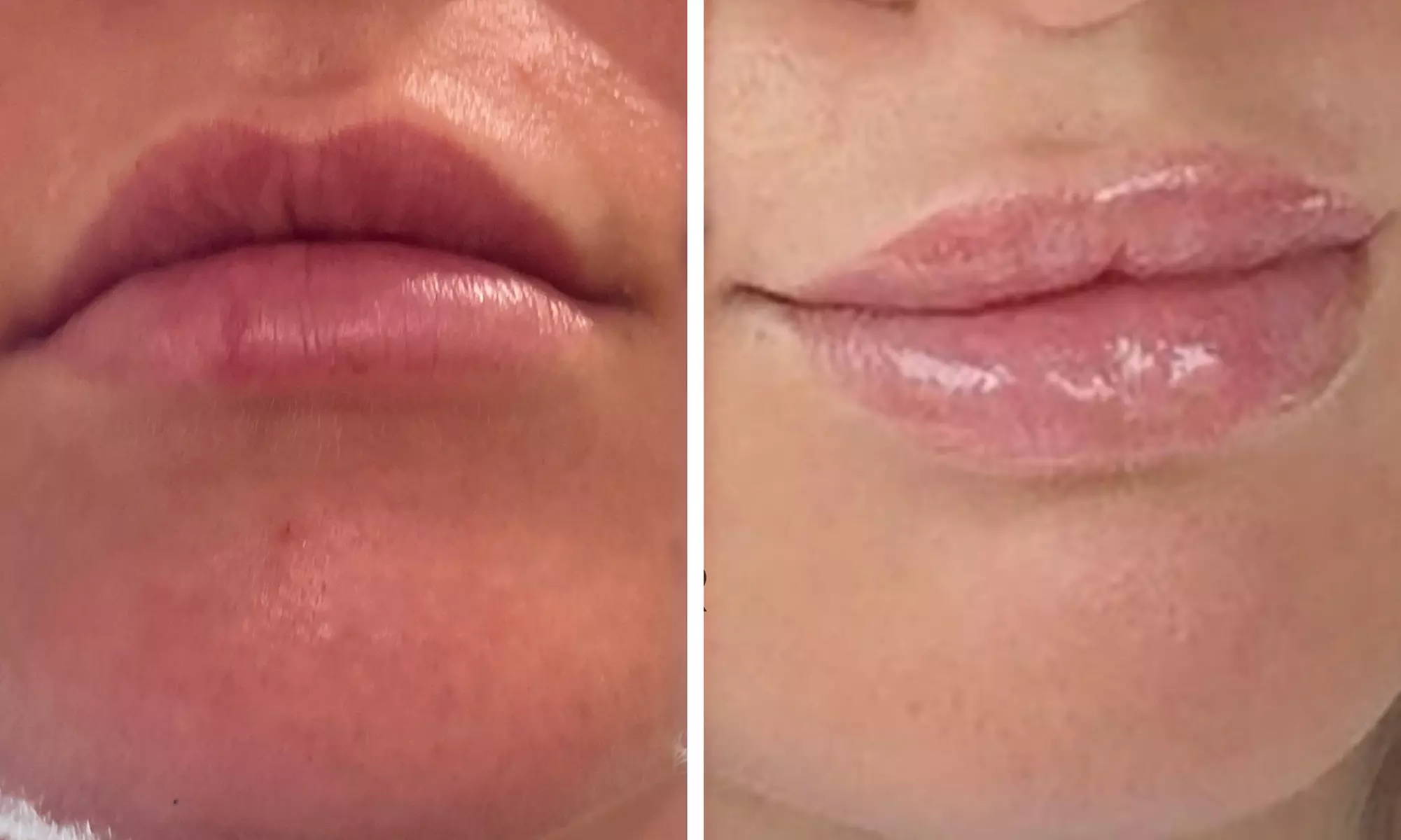 Half (0.55mL) or Full Syringe  (1mL) Lip Filler - Limited Time Deposit
