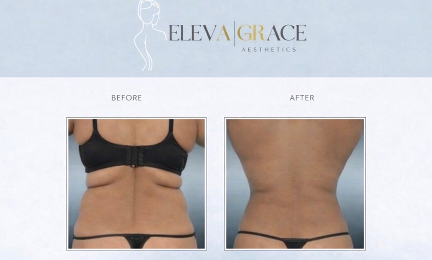Image 4: Up to 94% off on Laser Lipo and Ultrasonic Cavitation Treatments