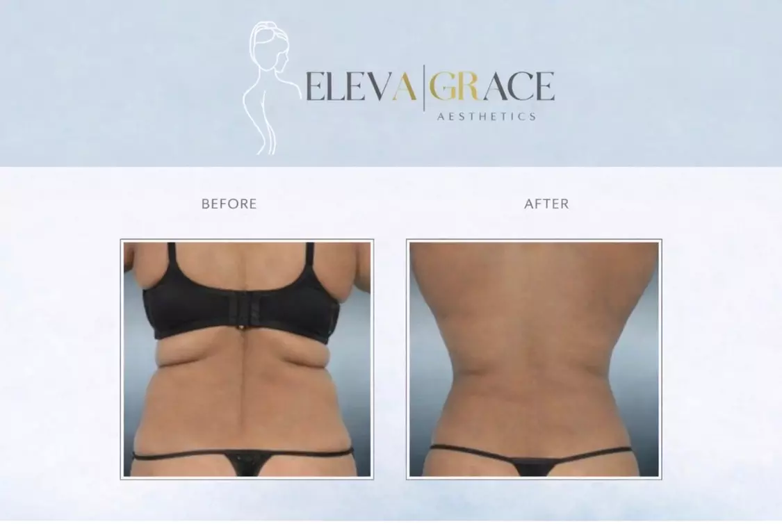 Up to 94% off on Laser Lipo and Ultrasonic Cavitation Treatments