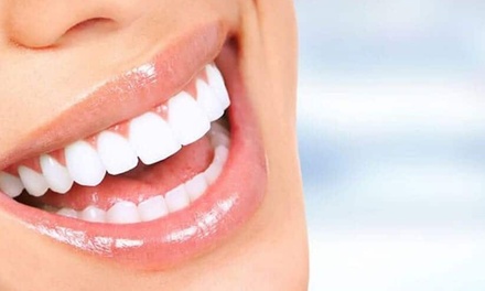 1 carilla dental de composite incluye scanner de diseño de sonrisa - Ident Lab Clinica Estetica Dental