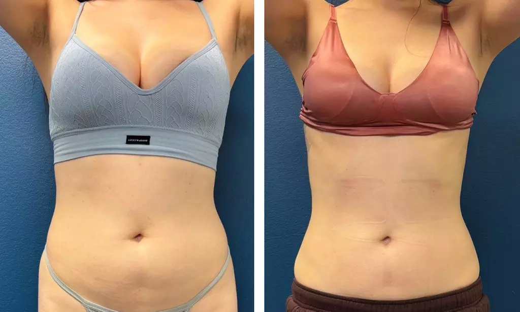 Deluxe Lymphatic Drainage & Body Sculpt Sessions