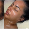 Image 2: One or Three Sessions of Micro needling with Optional LED Light 