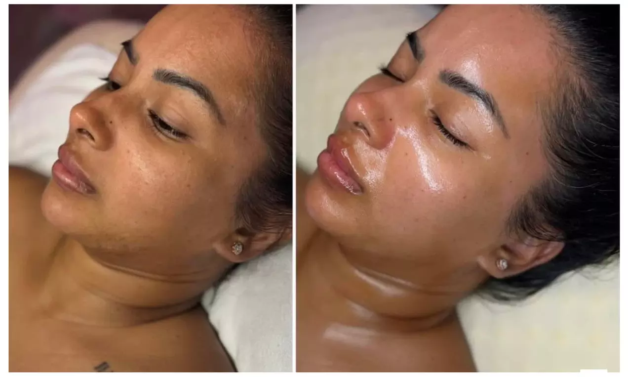 One or Three Sessions of Micro needling with Optional LED Light