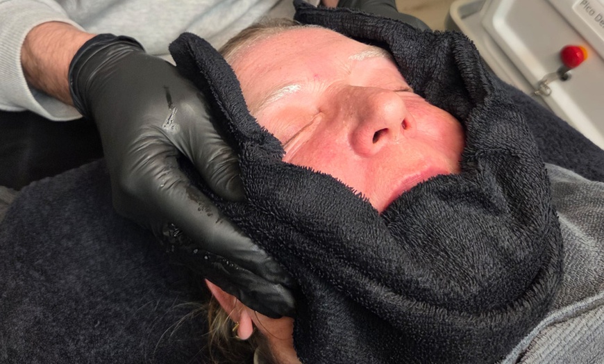 Image 2: Effectieve carbon laser peeling voor huidverjonging en collageenboost