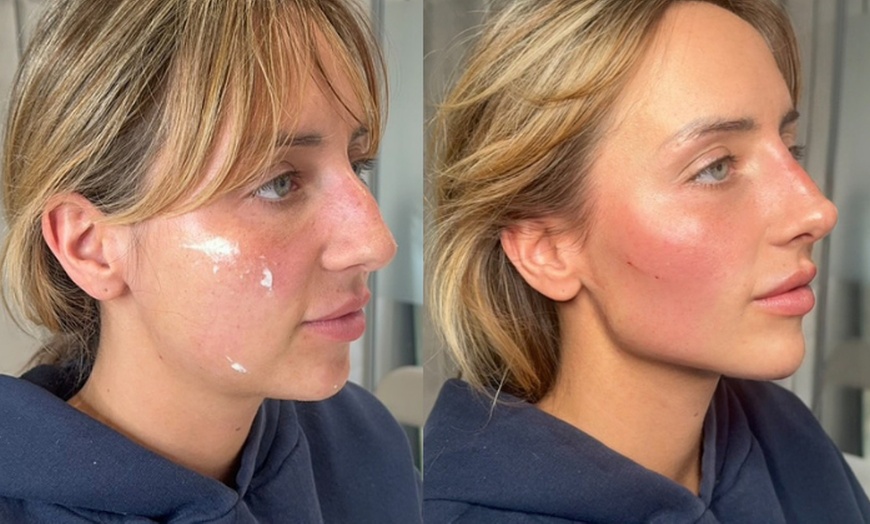 Image 2: Up to 37% Off on Filler at Age Management Optimal Wellness
