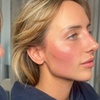 Image 2: Up to 37% Off on Filler at Age Management Optimal Wellness