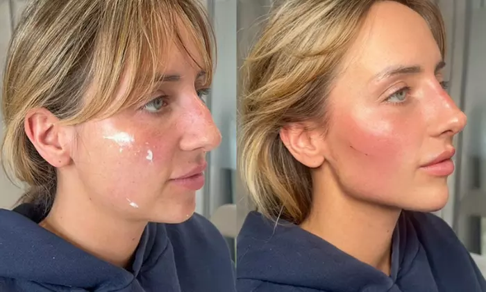 Up to 37% Off on Filler at Age Management Optimal Wellness