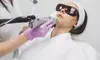 Feel Fresh with One Session of Laser Hair Removal – Underarms, Full Face, Bikini, Brazilian ( Up to 72% Off )