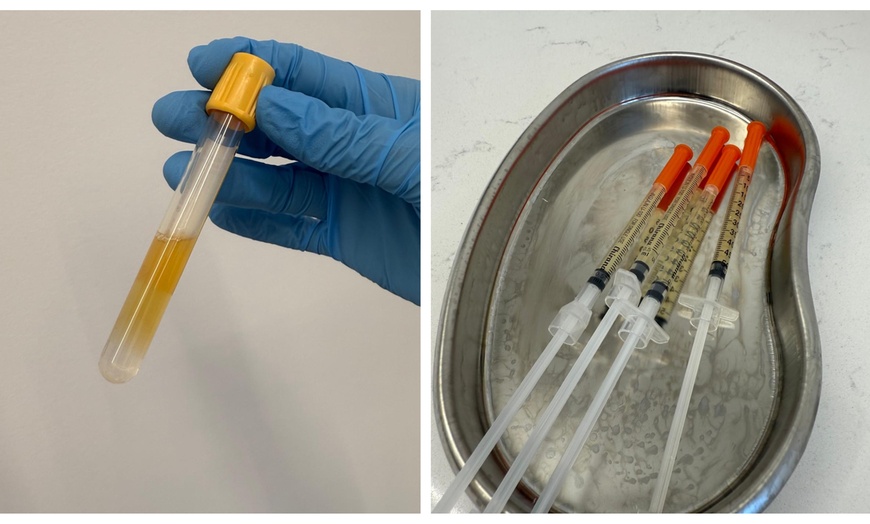 Image 3: Up to 50% Off on Vampire Facelift at The Aesthetic Clinic by Dr Sabbia