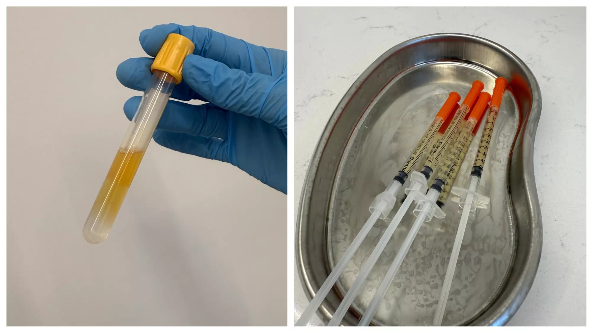 Up to 50% Off on Vampire Facelift at The Aesthetic Clinic by Dr Sabbia - Image 3