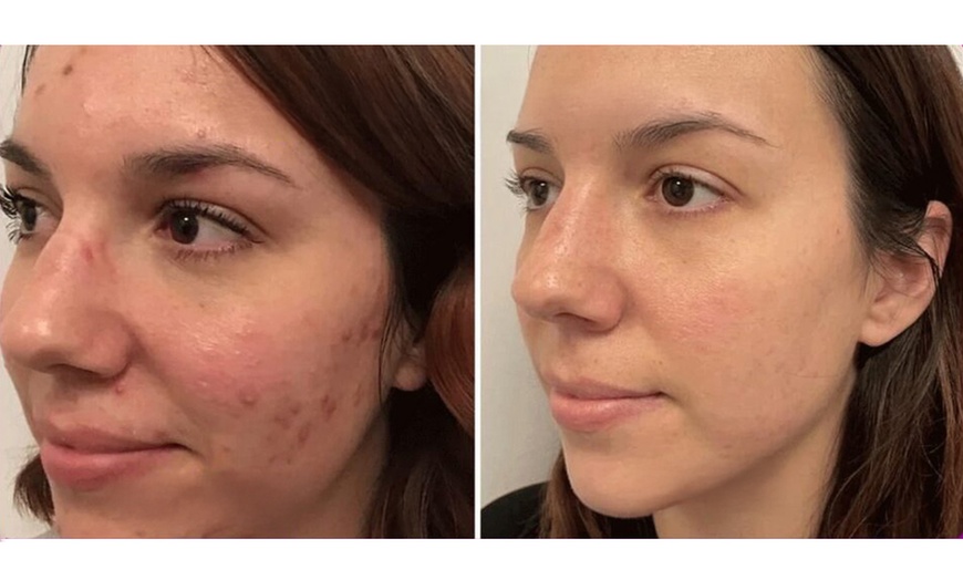 Image 2: Refresh Your Look with Hydra Facial