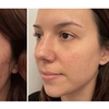 Image 2: Refresh Your Look with Hydra Facial