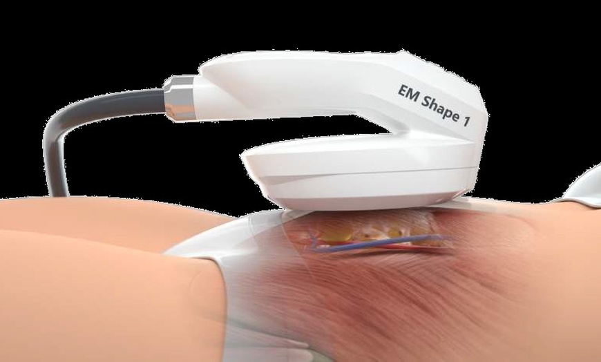 Image 4: EMSculpt (EMS Medisculp) at Cryojuvenate