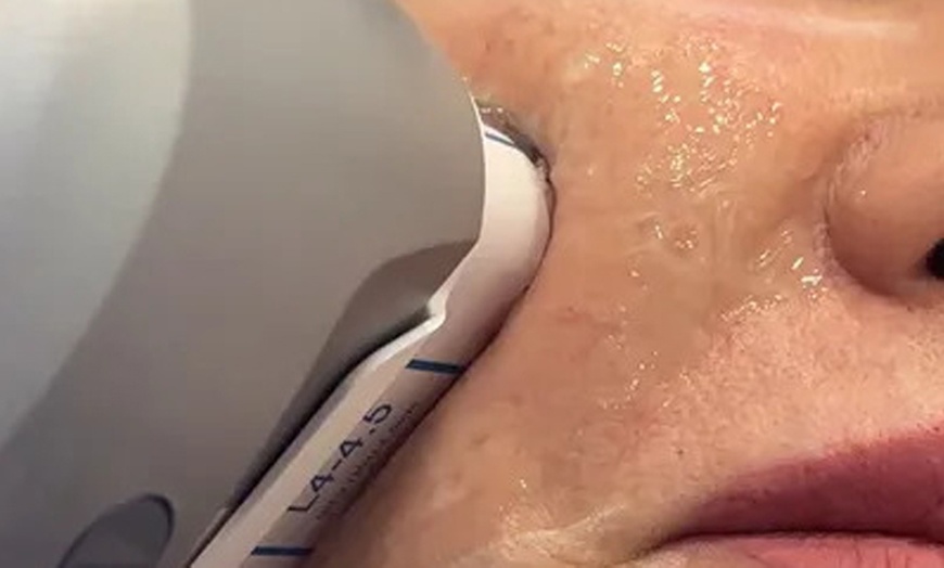 Image 1: 1 HIFU Non-Surgical Lift (Double Chin, Jawline and Chin, or Full Face)