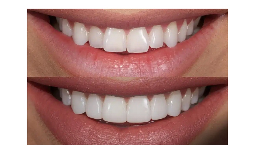 Image 2: Up to 63% Off on Dental Checkup (Cleaning, X-Ray, Exam) at Veralis