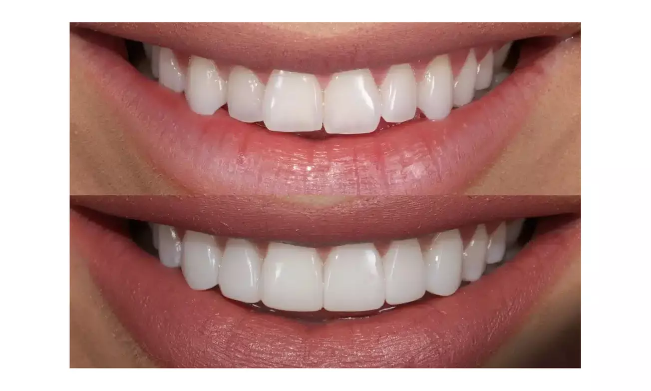 Up to 63% Off on Dental Checkup (Cleaning, X-Ray, Exam) at Veralis - Image 2