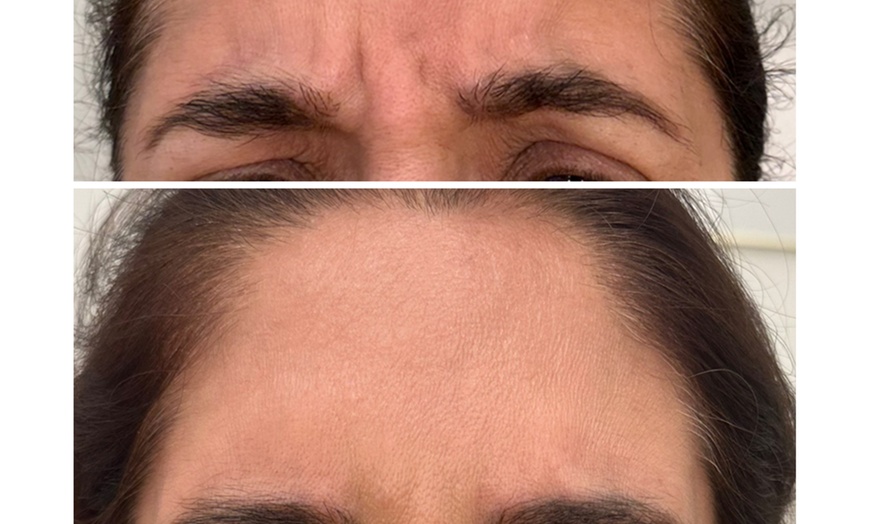 Image 9: Revitalize with 30 or 60 Units of Dysport at Youthful Glow