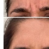 Image 9: Revitalize with 30 or 60 Units of Dysport at Youthful Glow