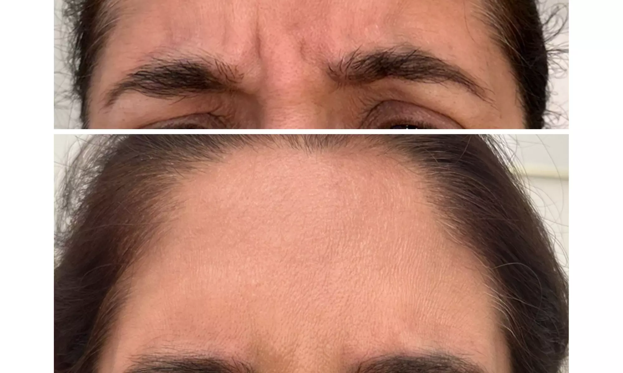 Revitalize with 30 or 60 Units of Dysport at Youthful Glow