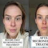 Image 1: Unlock Radiance with One, Two, or Three Micro needling Sessions