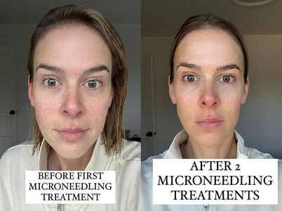 Microneedling - 1 Session - Marsil Beauty And Aesthetics