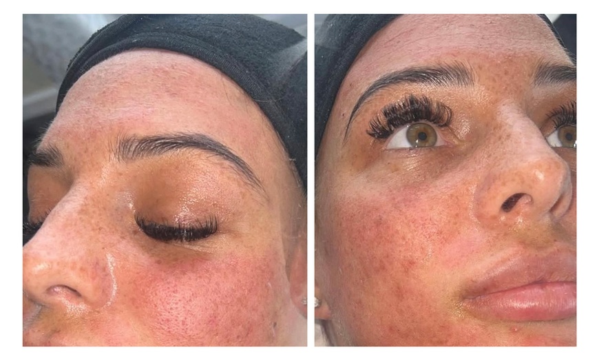 Image 3: One or Three Micro-Needling Facials with/without Skin Boosters