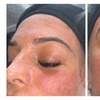 Image 3: One or Three Micro-Needling Facials with/without Skin Boosters