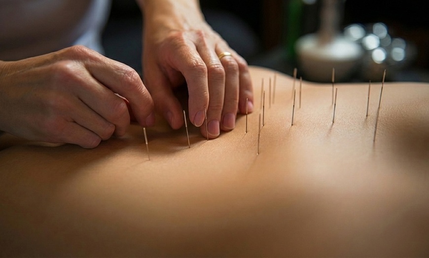 Image 4: Acupuncture with Optional Cupping for Pain Relief & Whole-Body Balance