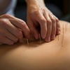 Image 4: Acupuncture with Optional Cupping for Pain Relief & Whole-Body Balance
