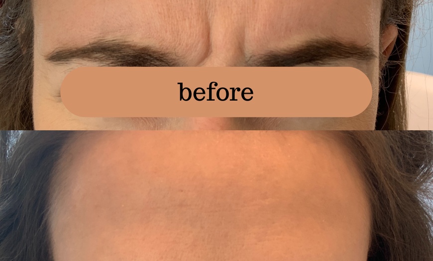 Image 4: Smooth Fine Lines & Wrinkles with Professional Botox Injections