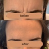 Image 4: Smooth Fine Lines & Wrinkles with Professional Botox Injections