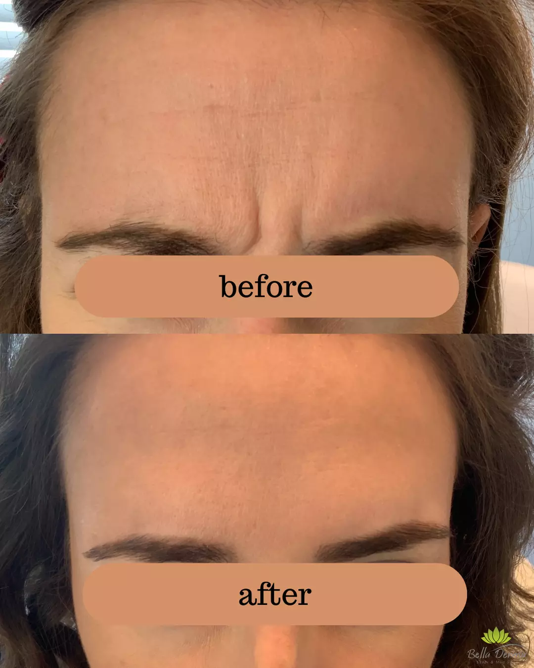 Smooth Fine Lines & Wrinkles with Professional Botox Injections