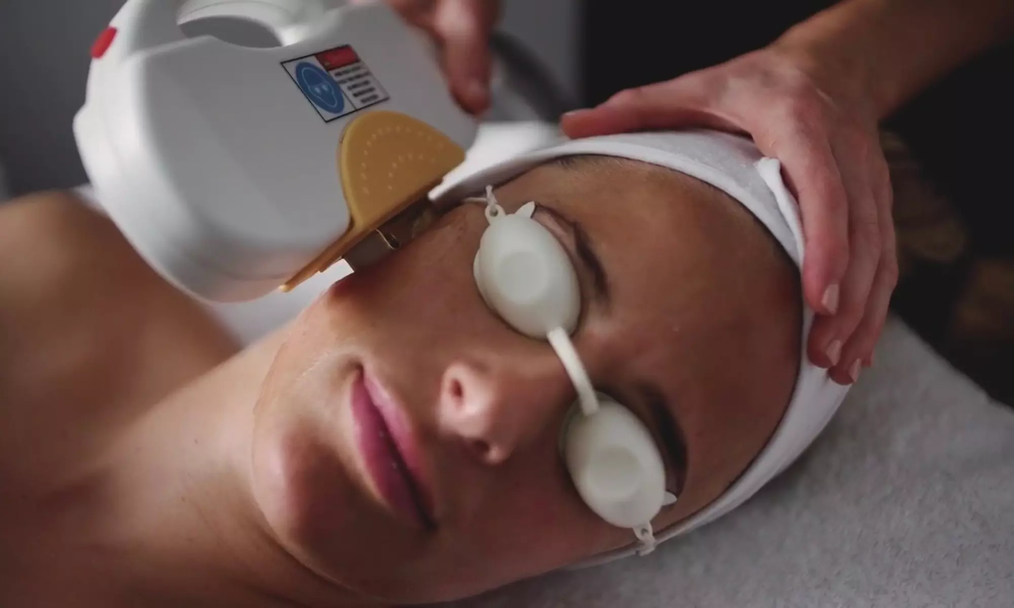 1 o 3 sesiones de tratamiento láser para manchas y acné