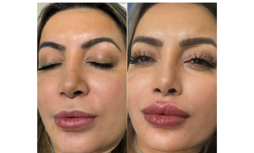 Image 4: Subtle to Full-Face Enhancements with 1ml, 2ml, or 3ml Dermal Filler 