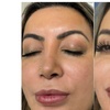 Image 4: Subtle to Full-Face Enhancements with 1ml, 2ml, or 3ml Dermal Filler 