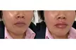 20, 40, or 60 Units of Xeomin with Optional One Syringe of Restylane Kysse Liora Aesthetics (Up to 65% Off) - Second Medium