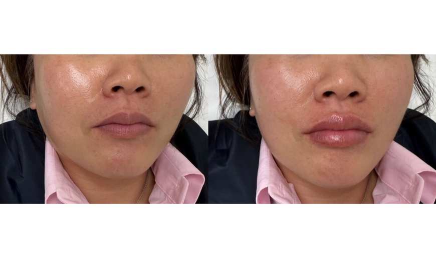 Image 3: 20, 40, or 60 Units of Xeomin w/ Optional 1 Syringe of Restylane Kysse 