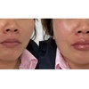 Image 3: 20, 40, or 60 Units of Xeomin w/ Optional 1 Syringe of Restylane Kysse 