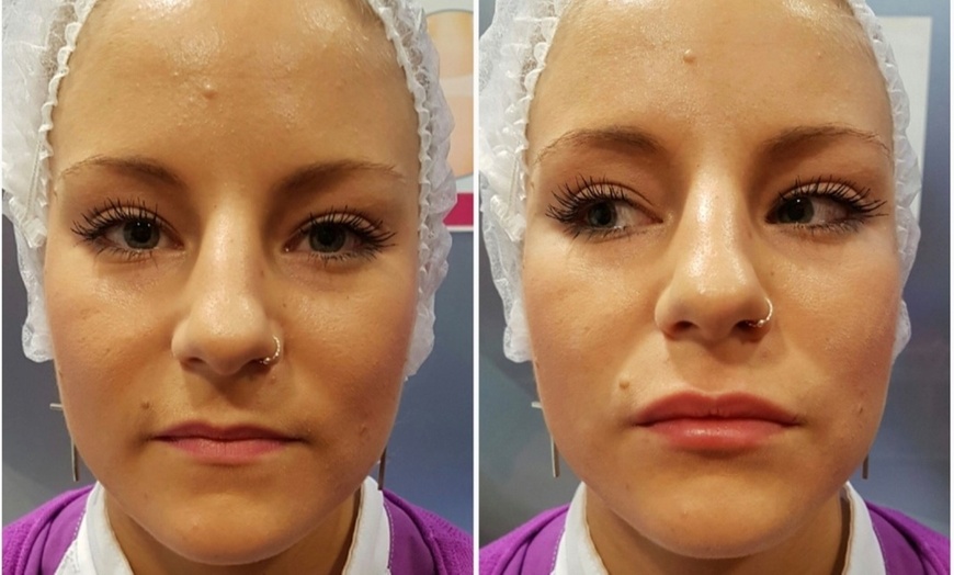 Image 5: Enhance Natural Beauty with Expert Dermal Filler Injections(0.5ml–2ml)